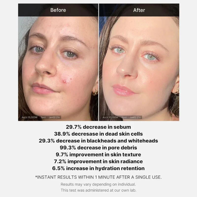 Medicube Red Acne Succinic Acid Peel